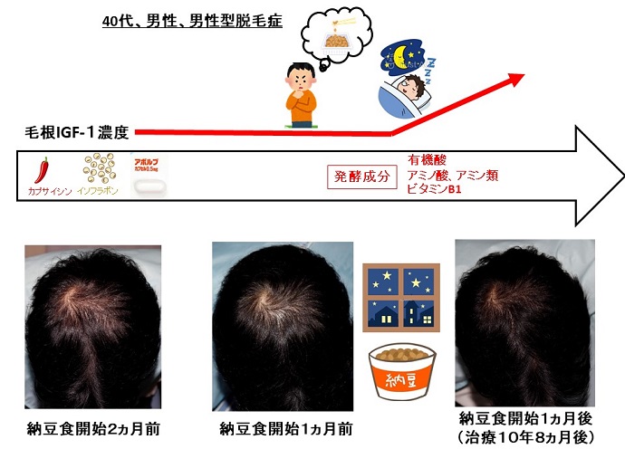 円形脱毛症　病院